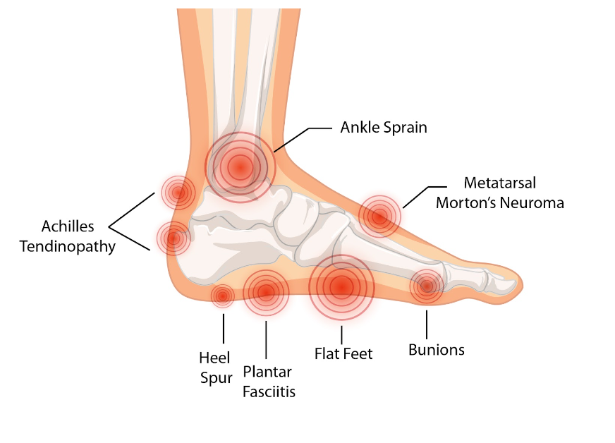 Foot pain chart Understanding your foot pain OrthoFlexx