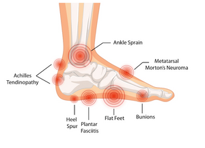 Foot pain chart: Understanding your foot pain