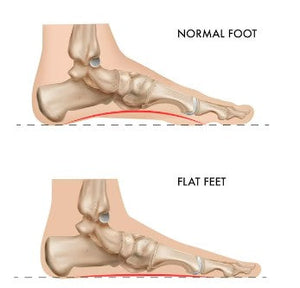 Disadvantages of having flat feet