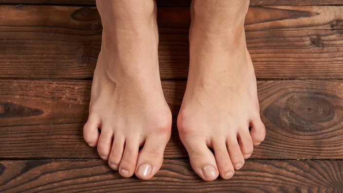 Identifying Symptoms Of Bunions And Foot Distress