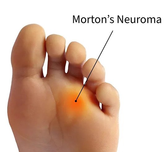 Foot Pain Indicative Of Morton's Neuroma