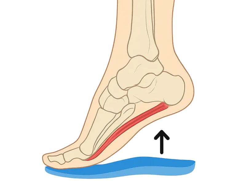 Arch support helps ease plantar fasciitis