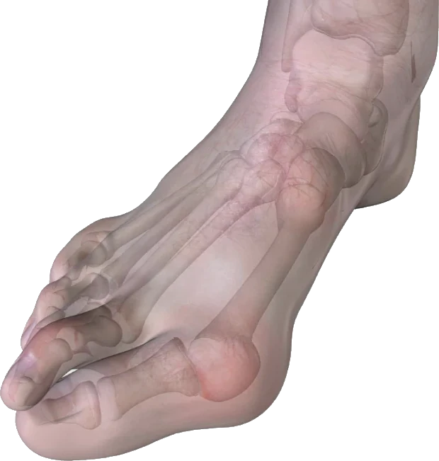 I Tried Bunion Corrector Sleeves, Toe Separators, and Arch Support. 