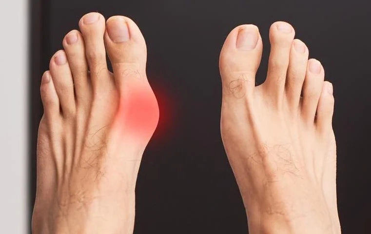 5 Mistakes Everyone With Bunions Makes