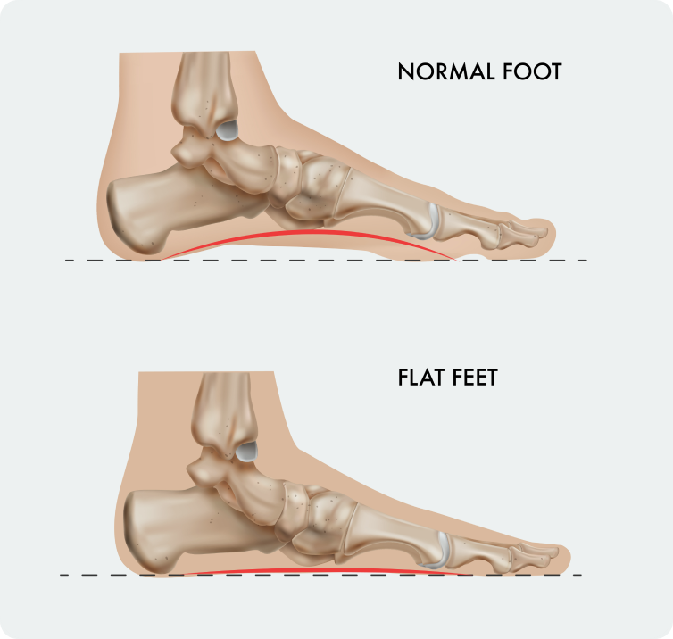 Flat feet and fallen arches