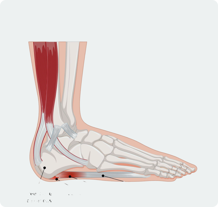 Plantar fasciitis