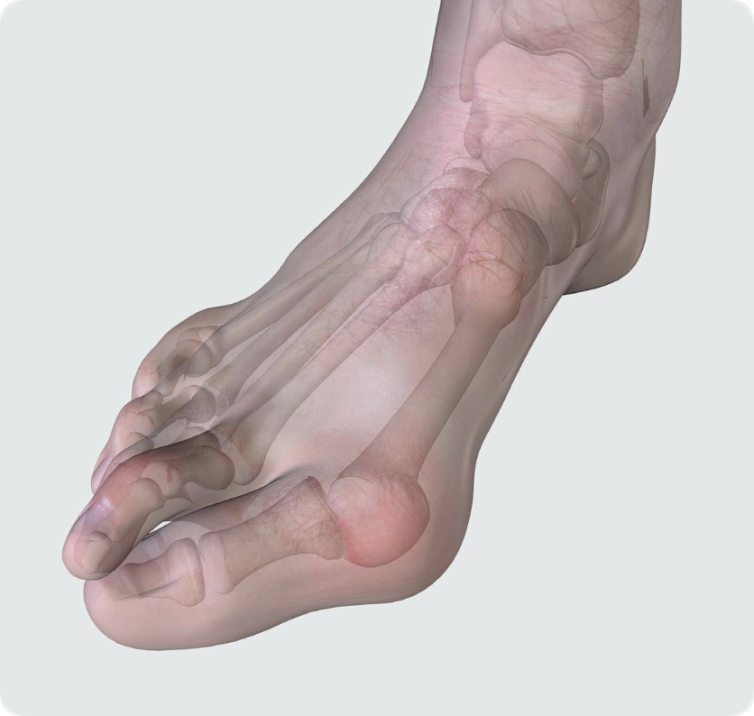 Bunions