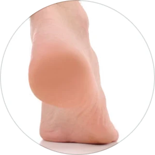 Plantar Fasciitis