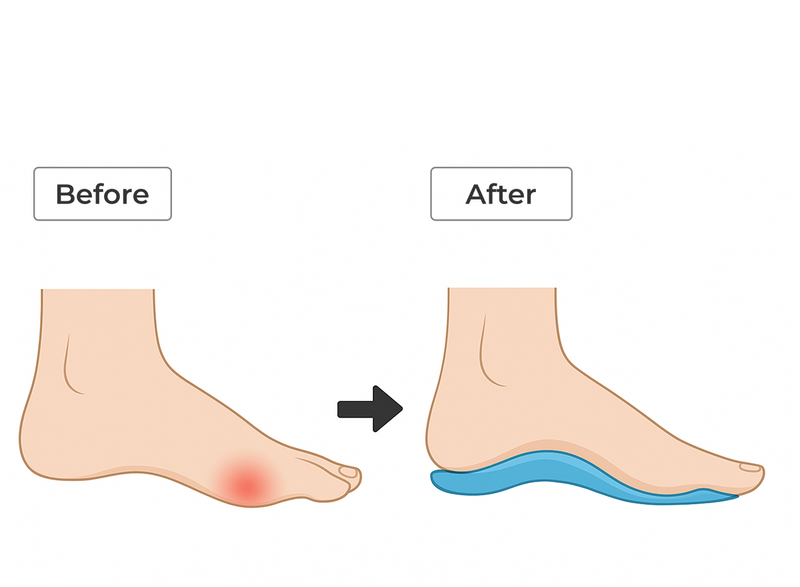 Arch supports are a non-surgical option for bunions